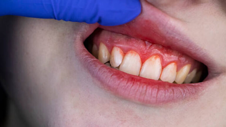ब्रश करते समय कहीं आपके दांतों से भी तो नहीं आ रहा खून, खतरनाक बीमारी के हैं लक्षण